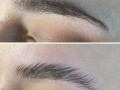 Brow Lift
